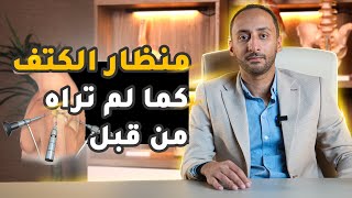 عملية منظار الكتف وكل ما تريد معرفته عن اسبابها ومدته ونسبة نجاحها