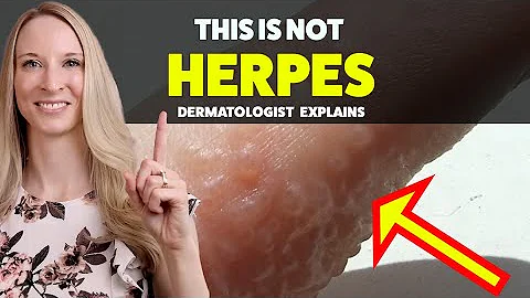 Dyshidrotic Eczema - Diagnosis, Treatment, Home Tips, Dermatologist Explain