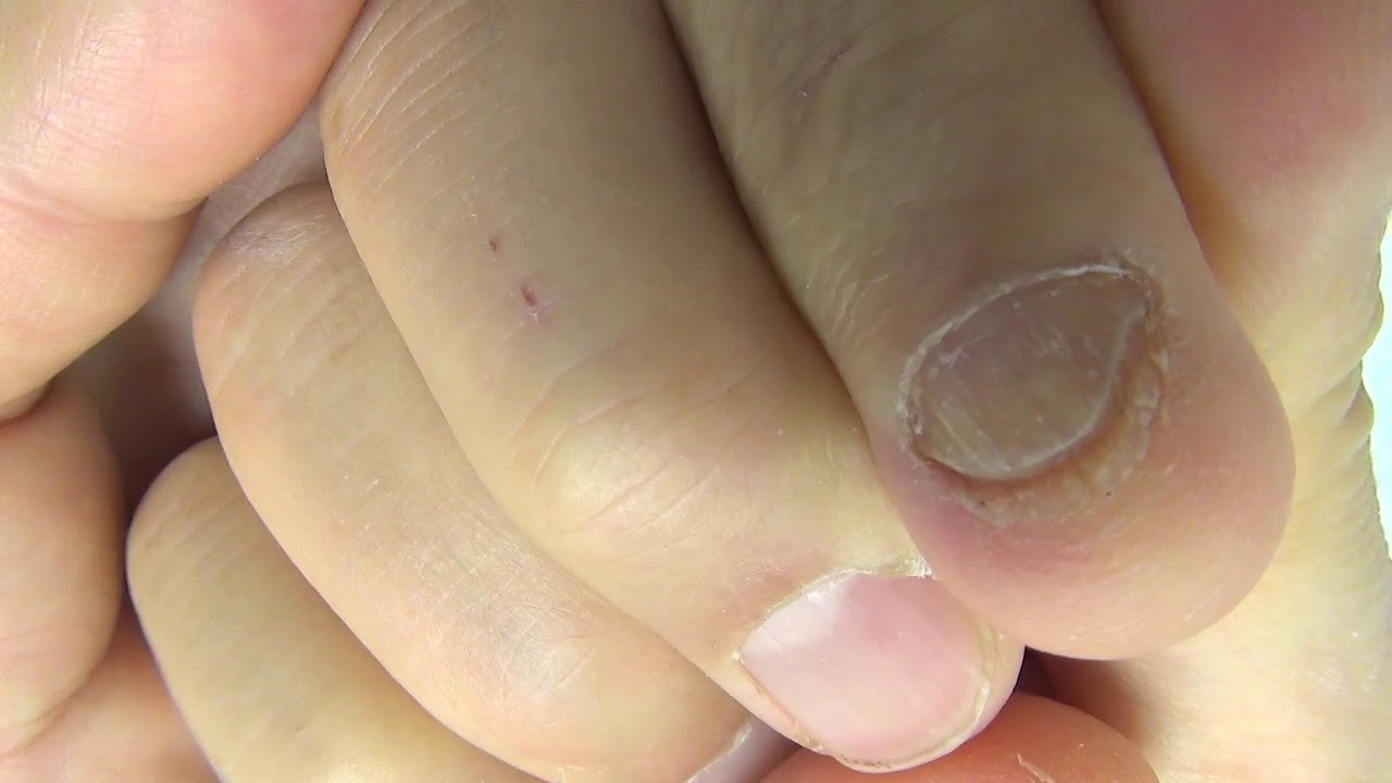 爪水虫外用薬治療1年半の経過 Youtube