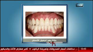 الدكتور | الجديد في عالم تجميل الأسنان وتصميم الابتسامة مع د.شادي علي حسين