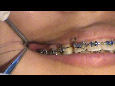 Uprighting Molars Youtube