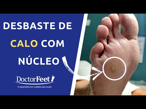 Vídeo: Como saber se você tem fungo nas unhas: 15 etapas