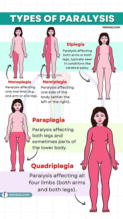 Types of Paralysis Explained | Monoplegia vs Hemiplegia vs Paraplegia