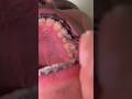 FINALLY! They pulled this out of my tooth! 🤮