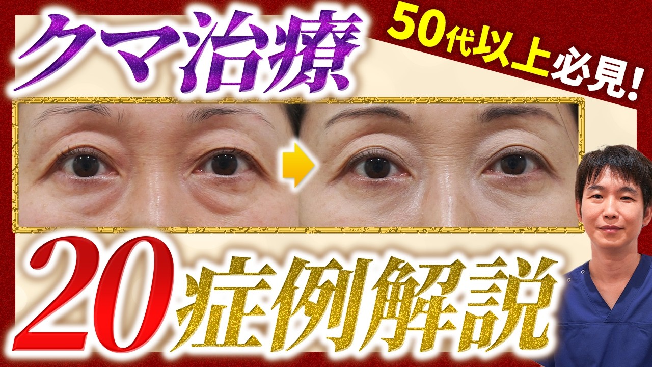 【保存版】50代以上のクマ治療を20症例解説！目の下のたるみの原因からクマ取りの適応について詳しく解説します！※男性症例あり【脱脂 / 表ハムラ / 裏ハムラ】