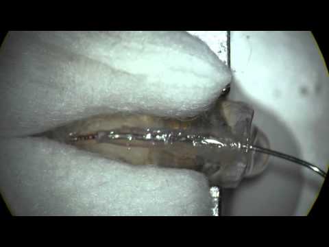 BF Removal With MT Bur