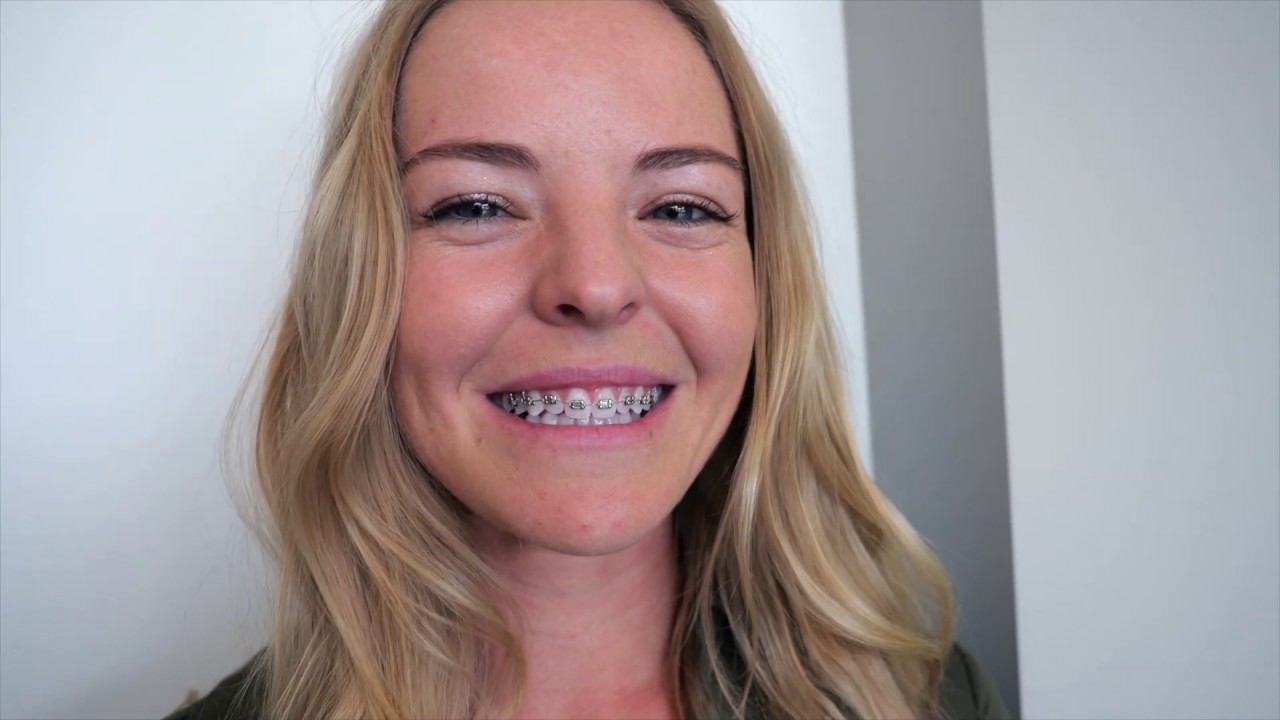 Braces Application Process Sonoran Smile Orthodontics YouTube