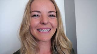 Braces Application Process | Sonoran Smile Orthodontics