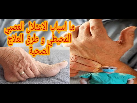 ما اسباب الاعتلال العصبي المحيطي وخز و خدران و حرقة و حرارة  اليدين و القدمين  و طرق العلاج المتاحة