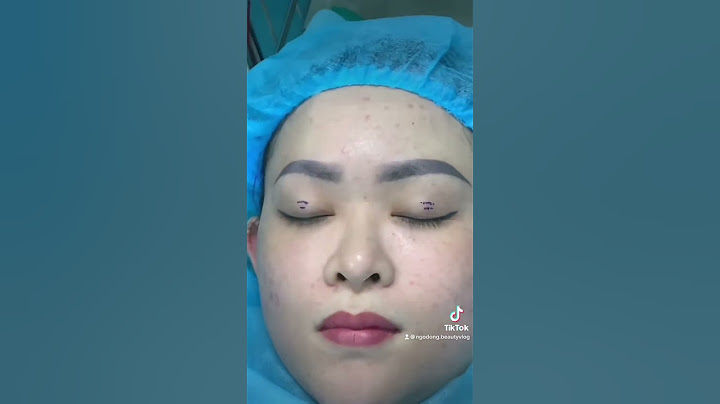 Cắt mí mắt đuôi phượng giúp đôi mắt tươi trẻ và dài hơn