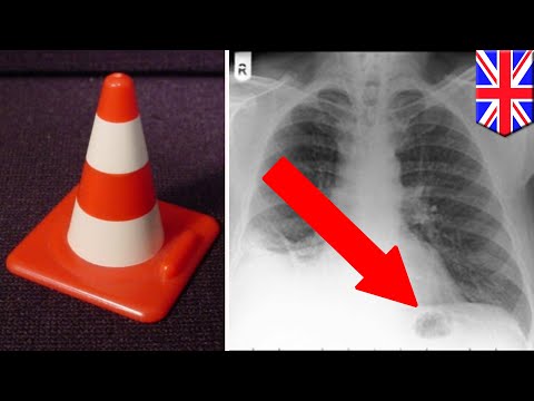 Lung Cancer? Man&rsquo;s cancer tumor turns out to be tiny Playmobil toy he inhaled as a kid - TomoNews