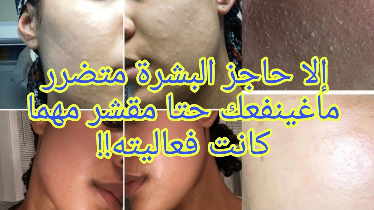 ضعف حاجز البشرة/ماذا يحذث لبشرتنا عند تضرر الحاجز/روتين لترميم حاجز البشرة المتضرر