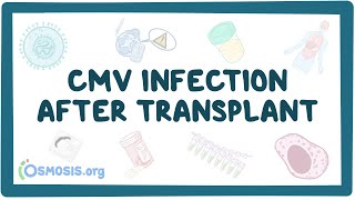 CMV infection after transplant