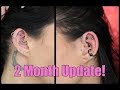 Helix Piercings 2 Month Update! | MASSIVE KELOIDS!