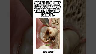 Watch how they remove decayed teeth. Its very painful