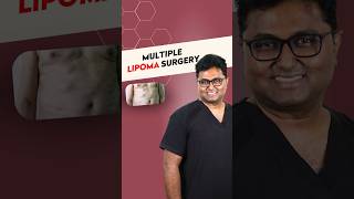 Multiple Lipoma Surgery - Dr. Karthik Ram - Chennai Plastic Surgery Net Worth