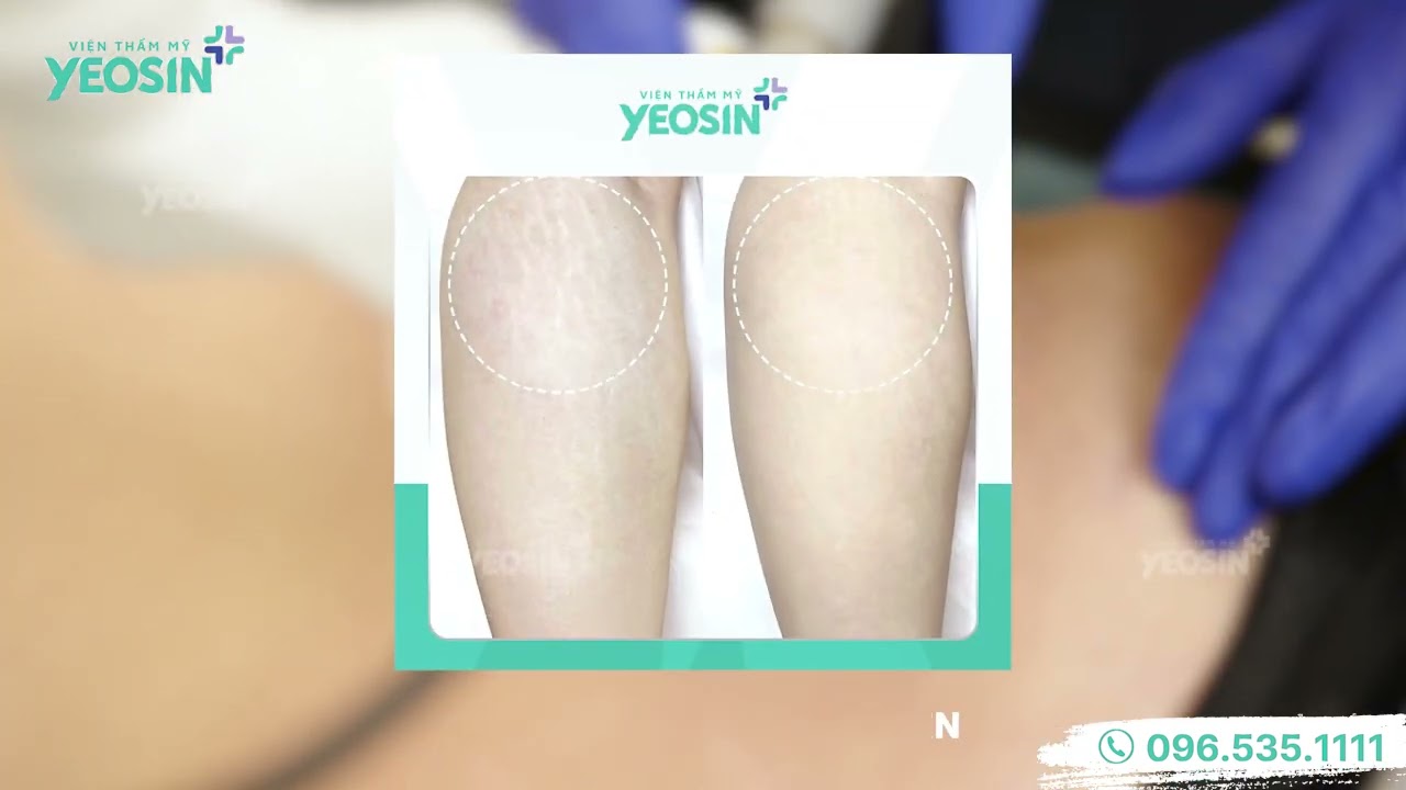 Điều trị rạn da bằng công nghệ Small Nano tại Viện Thẩm Mỹ Yeosin 25 YouTube video
