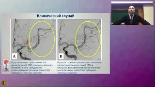 Современные подходы к диагностике и хирургическому лечению ишемического инсульта - Ардашев Вячеслав
