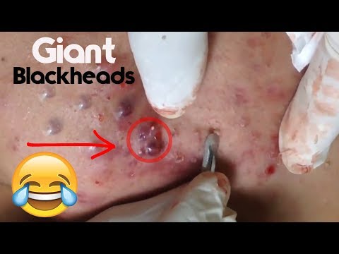 Blackheads, Cystic Acne, & Pimples Extraction On Face, Acne Treatment! 