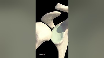 What Exactly Is a Dislocated Shoulder (Animation)