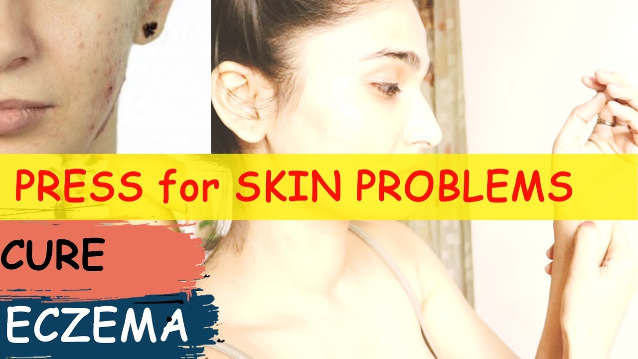 PRESS to CURE ECZEMA Natural treatment for Skin problems