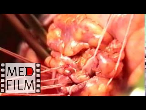 Операции при митральном пороке сердца © mitral heart disease