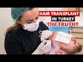 Hair transplant in Turkey: FUE, DHI, Everything you should know before your Hair Transplant (Part 1)