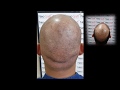 hair transplant side effects-Hair transplant repair with scalp micro pigmentation smp Hindi