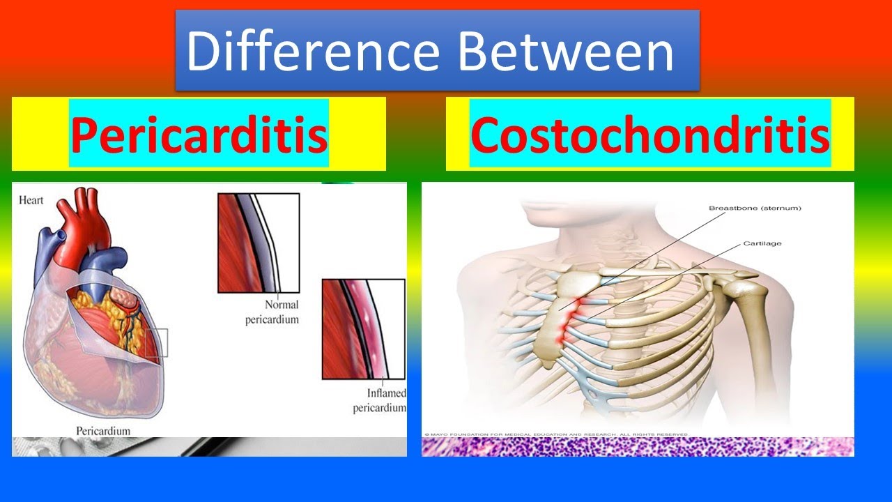 Difference between Pericarditis and Costochondritis YouTube