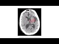 Cerebrovascular Disease for the USMLE Step 1