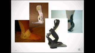 Step-Smart for Drop Foot  - Foot and ankle biomechanics screenshot 1
