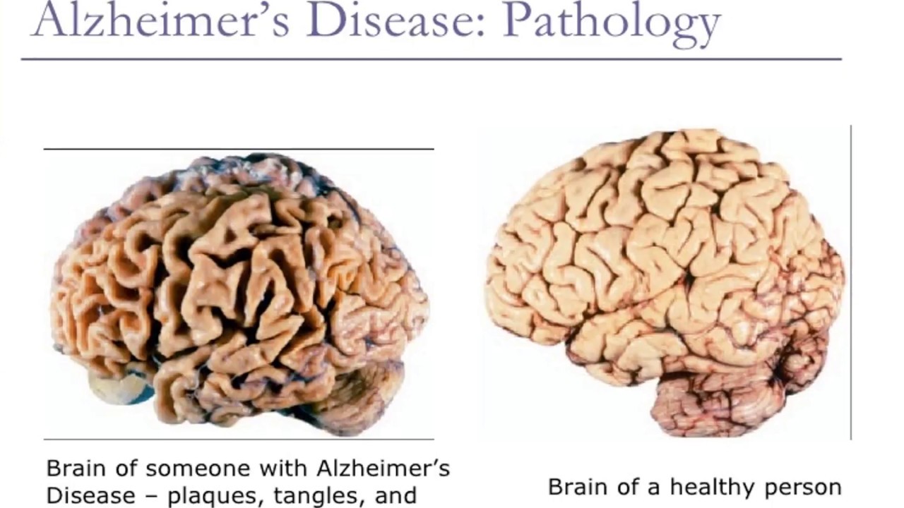 Brain disease. Болезнь Альцгеймера мозг. Мозг человека при болезни Альцгеймера. Головной мозг при болезни Альцгеймера.