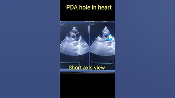 Patent ductus arteriosus ( PDA) hole in heart Echocardiography #youtubeshorts  #shorts