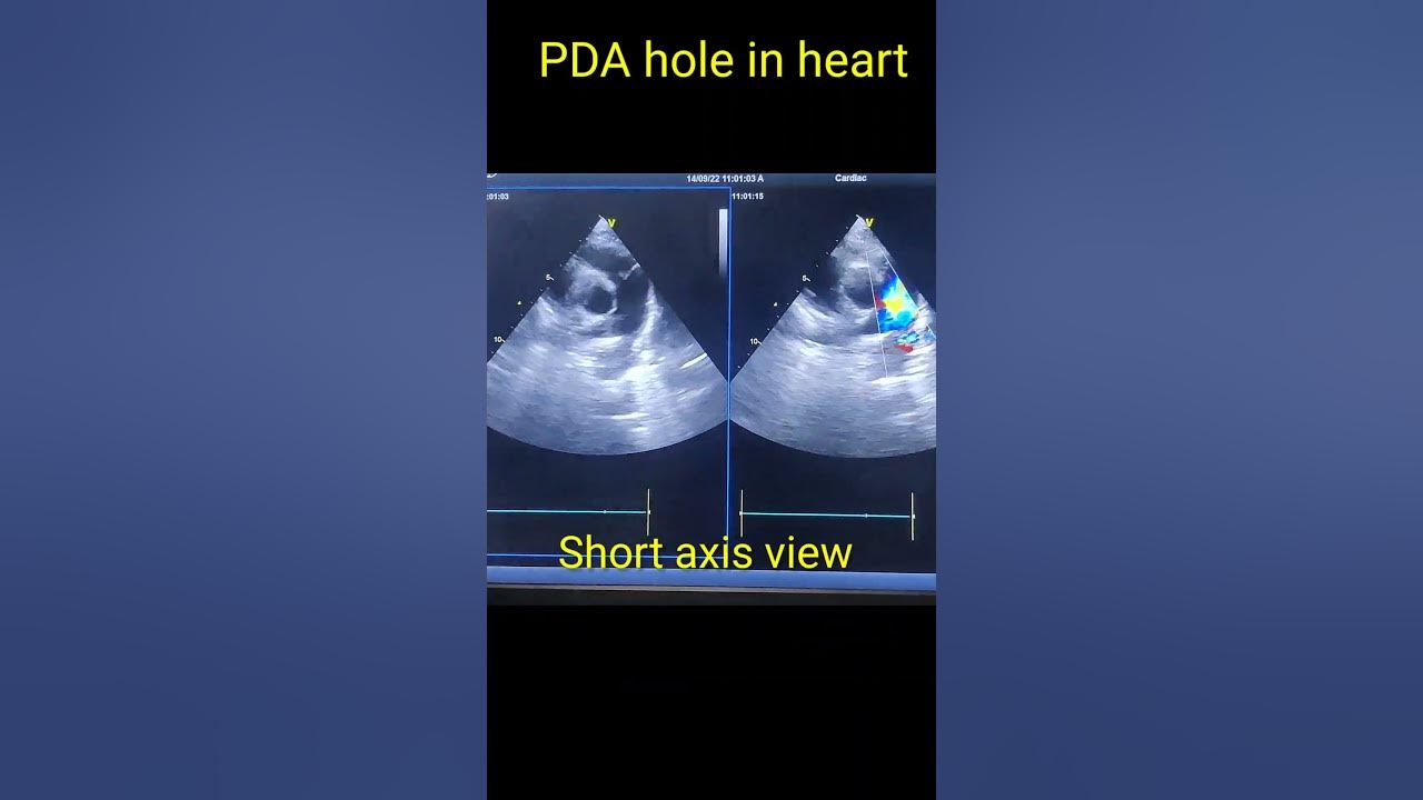 Patent ductus arteriosus ( PDA) hole in heart Echocardiography 