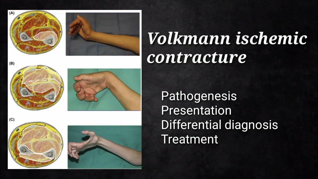 Volkmann ischemic contracture neuroscience neuroanatomy neurology medicalstudent YouTube