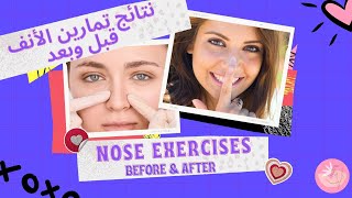 Nose Exercises Results! Before and After pics | نتائج تمارين الأنف! صور قبل وبعد