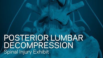 Posterior Lumbar Decompression - Spinal Injury Animation