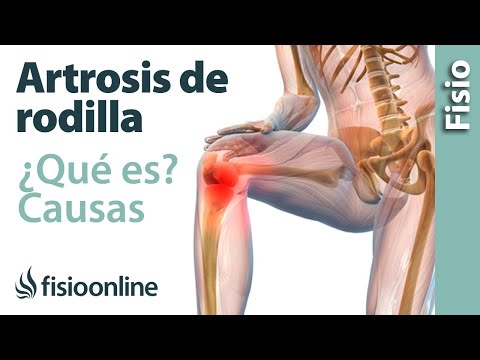 Vídeo: Osteoartritis De La Articulación De La Rodilla: Signos, Causas, Grado Y Tratamiento De La Osteoartritis De La Articulación De La Rodilla