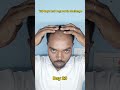 Day 29 | 180 days hair regrowth challenge #manmatters #lifeisbutadream #hairfallsolution #hairfall