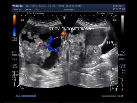 Endometriomas, also known as chocolate cysts or endometriotic cysts.