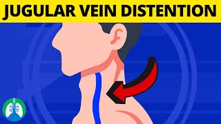 What is Jugular Venous Distention? (Medical Definition and Explanation)