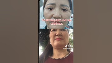 Mí mắt dưới bị lật ngửa, lỗi hỏng nặng, cái kết sau 2 năm quá mĩ mãn.