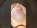 Cutting toenail.  #nail #toenail