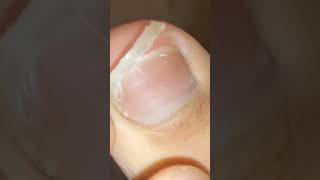 Cutting toenail.  #nail #toenail