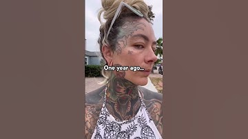 One year of tattoo removal progress