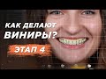 Виниры. Этап 4. 3D Моделирование улыбки (Wax-up). Виниры для зубов