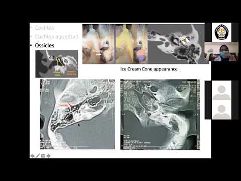 MSCT Scan Mastoid