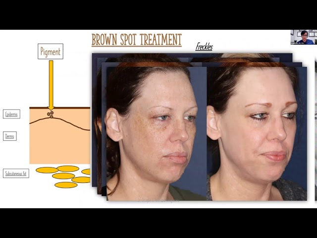 Banner for How to Eliminate Brown Spots and Red Spots With Lasers | Cosmetic Laser Dermatology Webinar