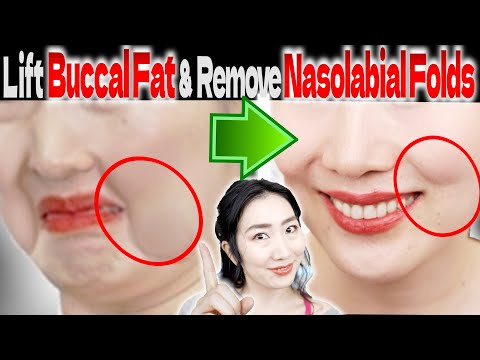 Lifting Buccal Fat is the Key to Remove Nasolabial Folds/ Lifting up the Corners of your Mouth