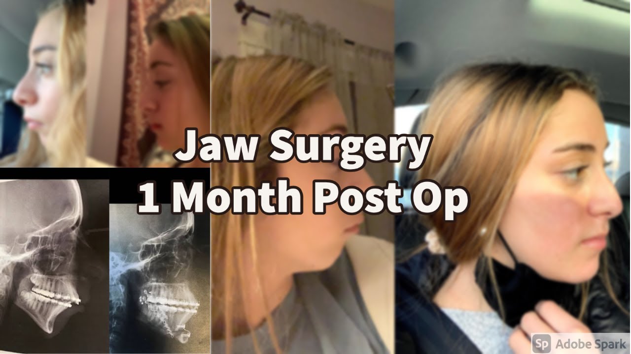 JAW SURGERY 1 Month Post-Op